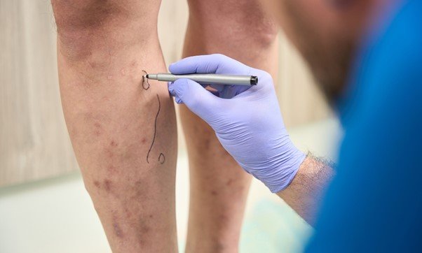 Exploring Sclerotherapy for Varicose Veins