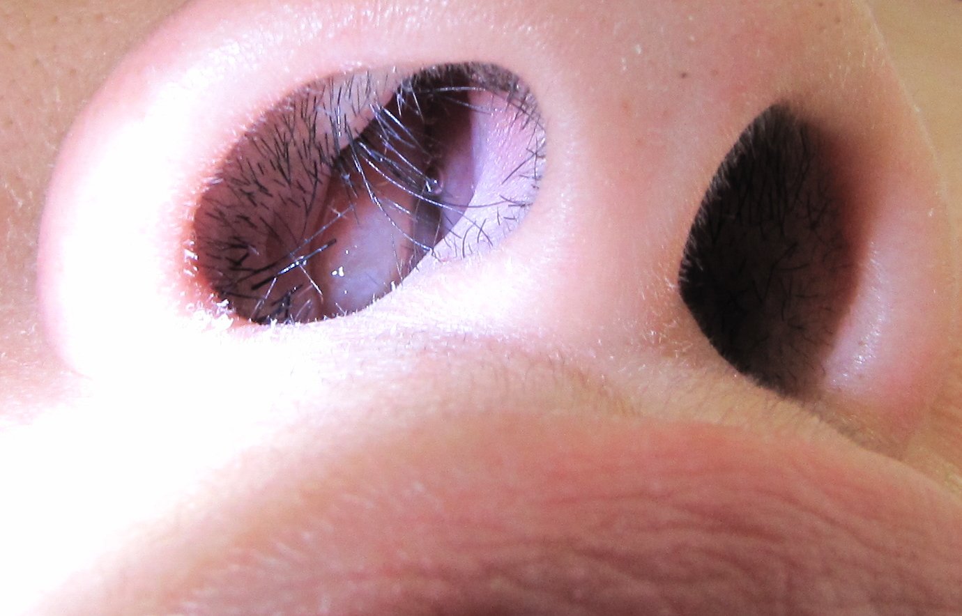 FAQs About Nasal Polyps