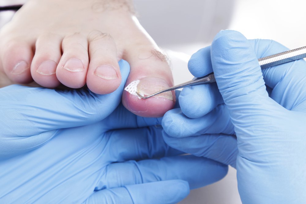 How Foot Specialists Can Help With Ingrown Toenails How Foot Specialists Can Help With Ingrown Toenails