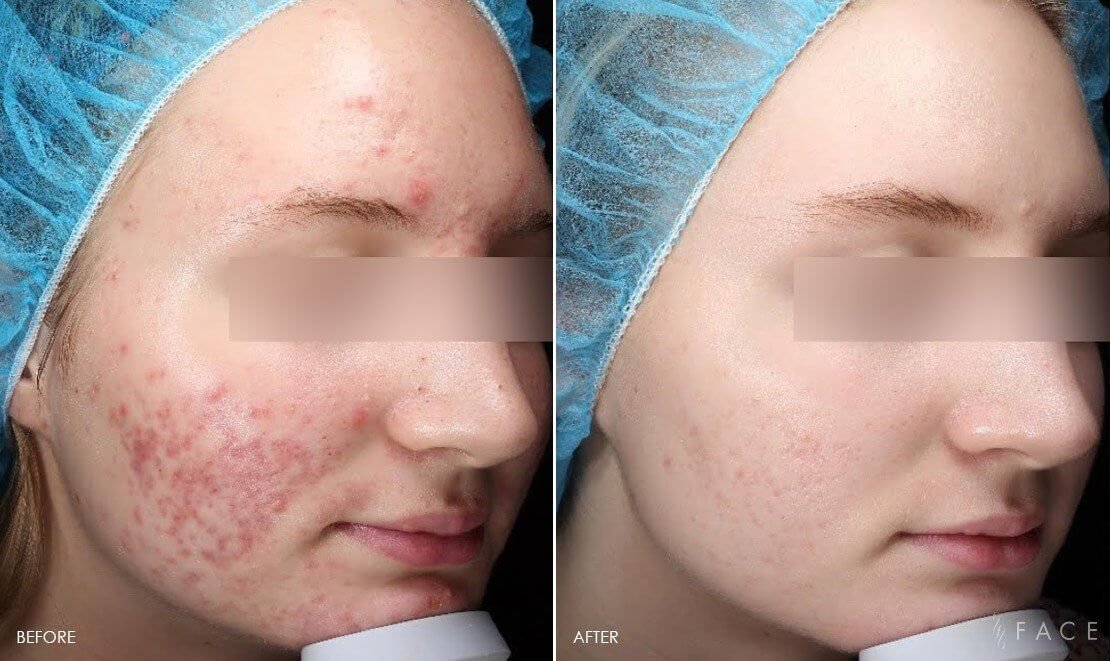 How Opus Colibri Enhances Skin Texture and Tone