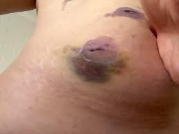 Lifestyle Changes To Make After Gallbladder Surgery Lifestyle Changes To Make After Gallbladder Surgery