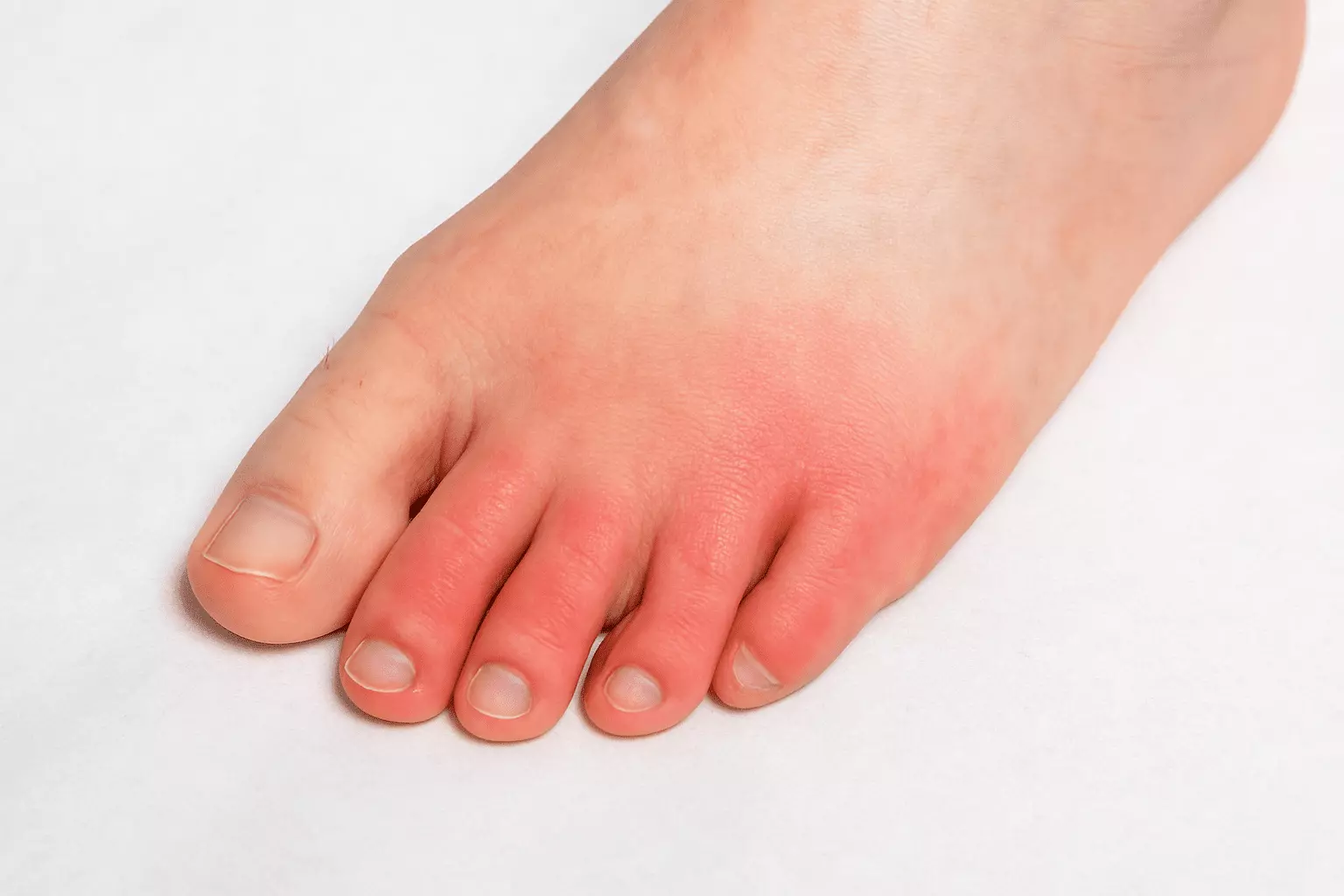 Recognizing Early Signs of Gout
