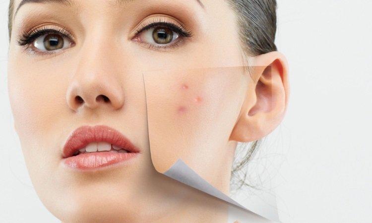 Understanding Chemical Peels and Their Benefits