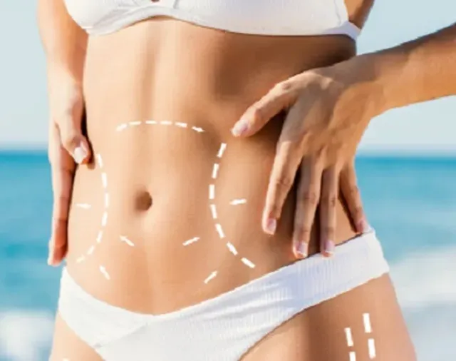 What Is Tummy Tuck Surgery?