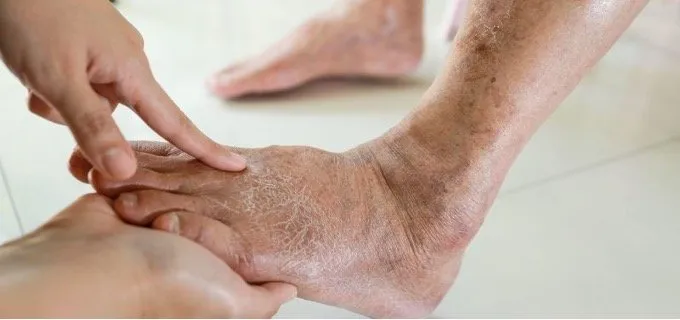 Tips for Living With Chronic Venous Insufficiency