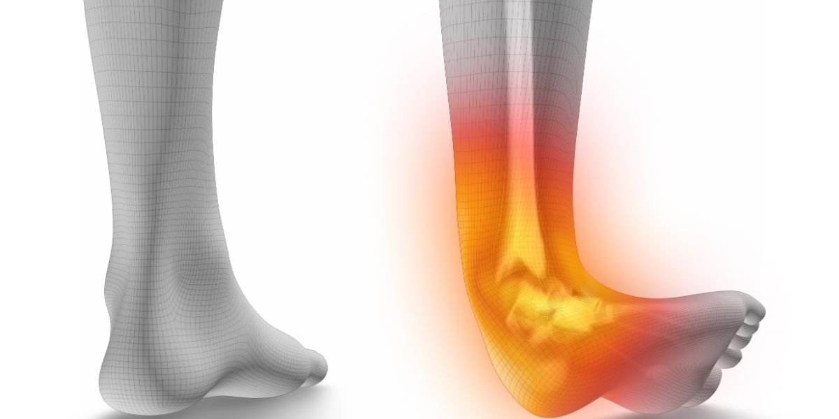 Understanding the Ankle Sprain Recovery Timeline