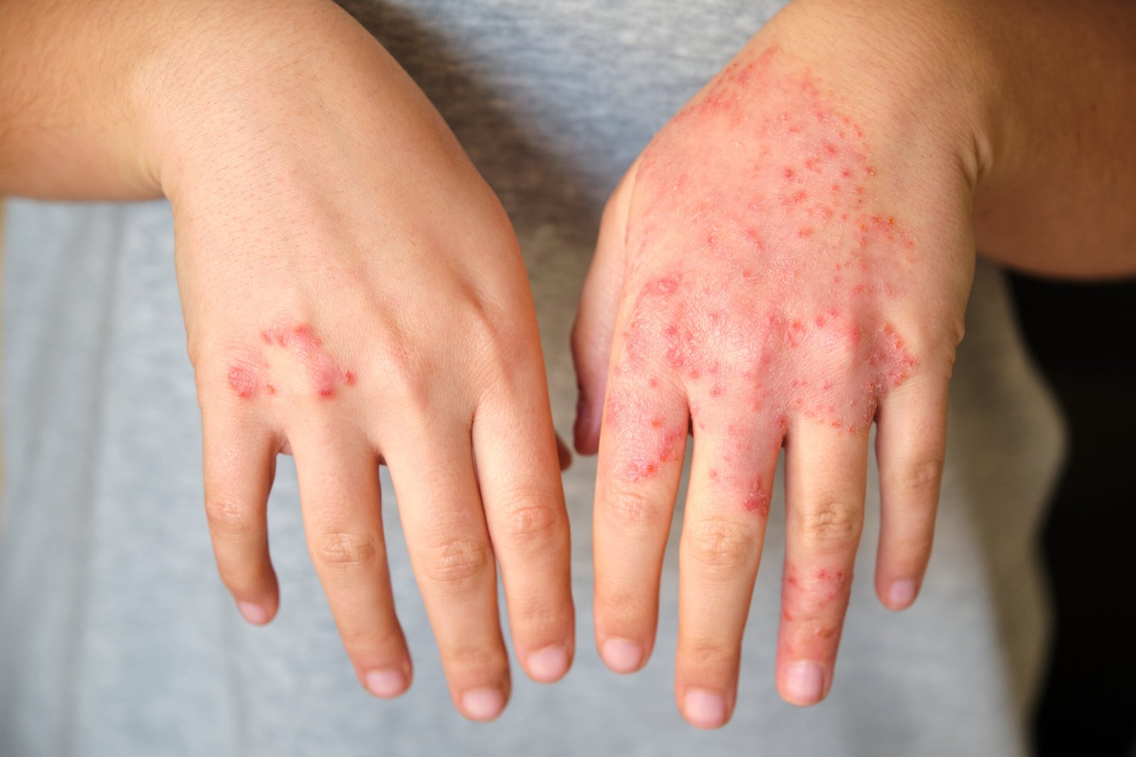 Unrecognizable woman with eczema on hands, atopic dermatitis. How Dermatologists Address Skin Allergies and Irritations
