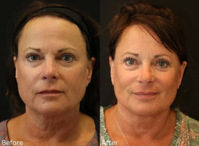 What To Know Before, During, and After Mohs Surgery